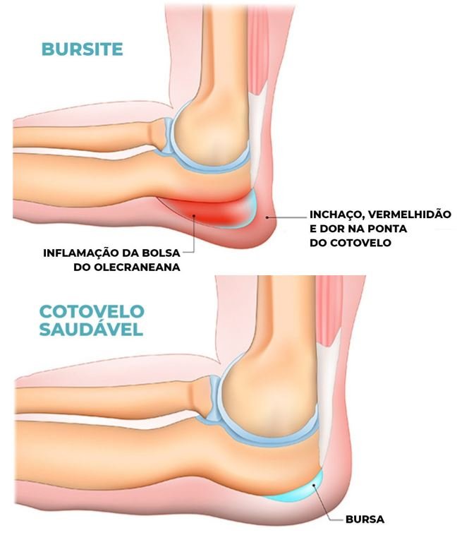 Epicondilite Lateral: A lesão mais recorrente no Beach Tennis